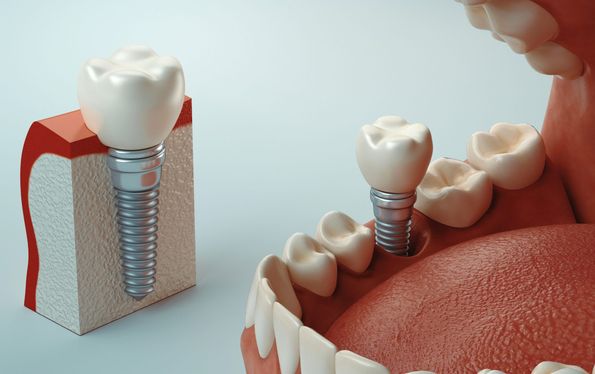 Neodent Clínica Dental protesis fija